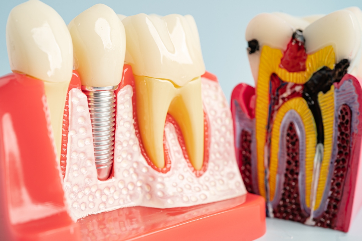 zirconia implants in sugar land