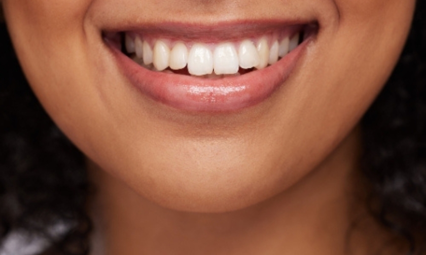 smile makeover make you look younger