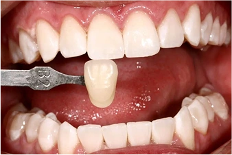 Dental Bridges Sugar Land | Luxe Dental Arts