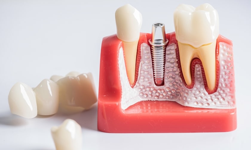 Is It Ever “Too Late” to Get Dental Implants?